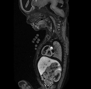 Fetal Scans
